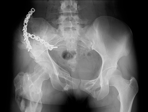 Pelvic ring fracture