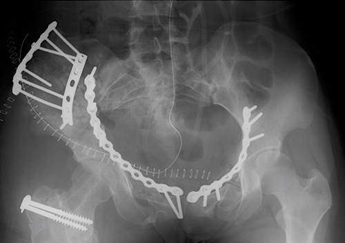 Pelvic ring fracture