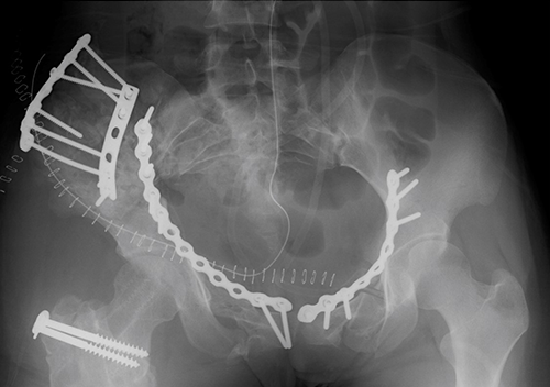 骨盤輪骨折