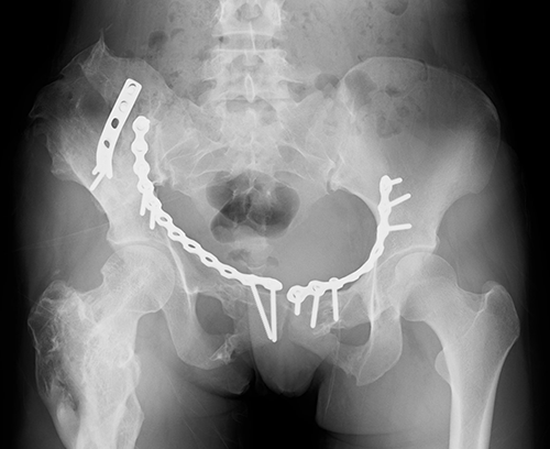 Pelvic ring fracture