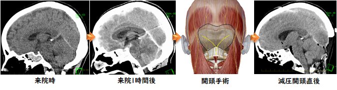 頭部外傷