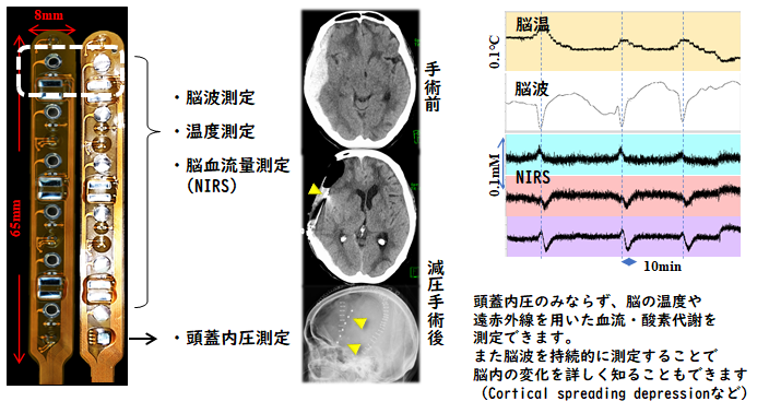 頭部外傷(重症頭部外傷)