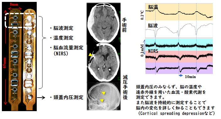 頭部外傷（重症頭部外傷）