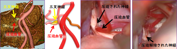 その他の脳神経外科疾患