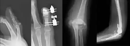 治療MRI