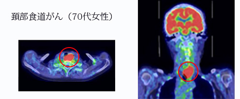 頚部食道がん