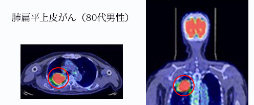 肺扁平上皮がん