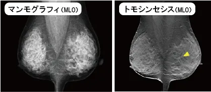 当院ではさらに精密な３Ｄマンモグラフィ（トモシンセシス）撮影が可能です