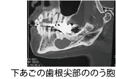 顎骨のう胞