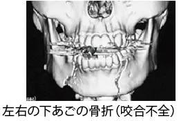 顎顔面骨骨折
