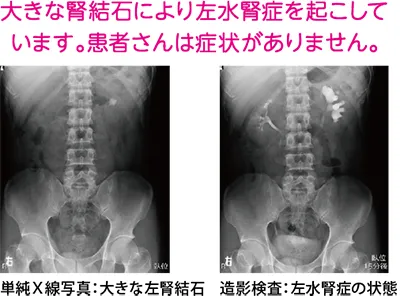 尿路結石は年々増加している