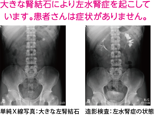 尿路結石破砕治療法