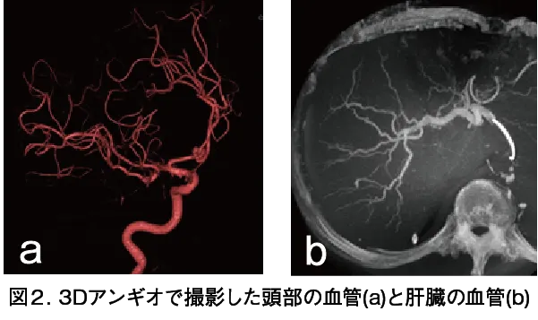 アンギオで撮影した頭部の血管と肝臓の血管