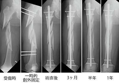 重度関節内骨折・関節外科