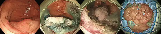 大腸ESD治療の写真
