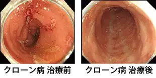 クローン病の治療前と治療後の写真