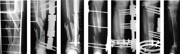 開放骨折後骨髄炎・骨欠損  骨短縮後骨移動術