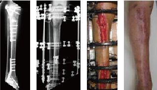 開放骨折後骨髄炎 マスカレ変法