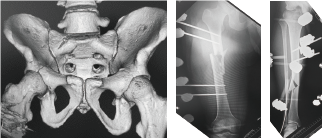 骨盤輪骨折