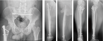 右大腿骨骨幹部骨折＋右脛骨腓骨骨幹部骨折：創外固定による一時的固定