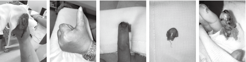 指切断指再接着：指尖部も条件が良ければ接着可能です。