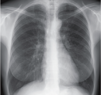 正常な肺