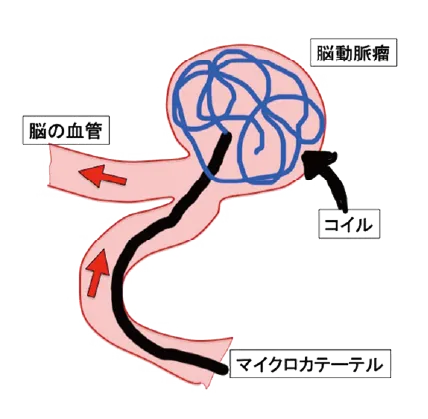 脳動脈瘤