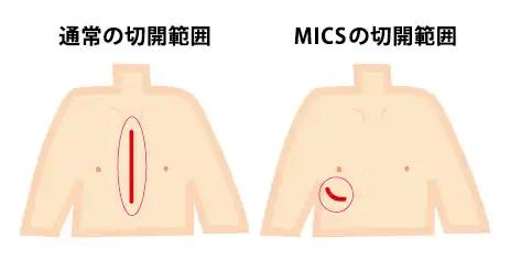 右小開胸下心臓手術の切開範囲
