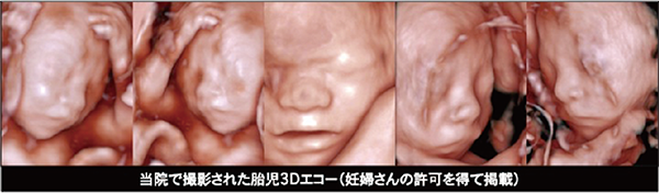 当院で撮影された胎児３Dエコー