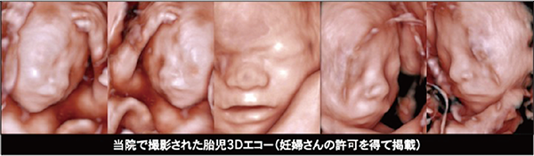 当院で撮影された胎児3Dエコー
