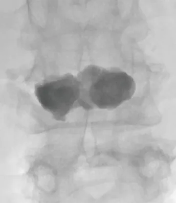 骨粗鬆症性圧迫骨折の椎体形成術