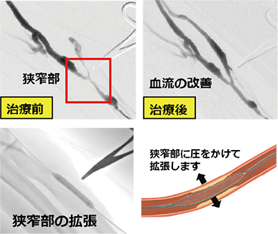 当科で行う透析関連の手術