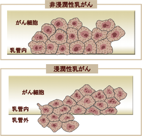 非浸潤性乳がん（早期乳がん）と浸潤性乳がん