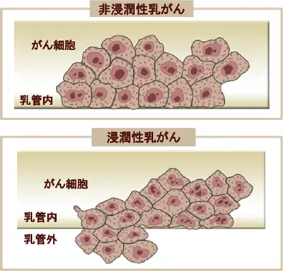 非浸潤性乳がん（早期乳がん）と浸潤性乳がん