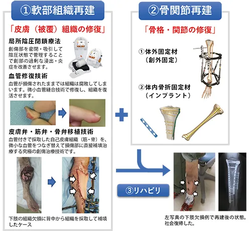 外傷再建に必要な治療技術
