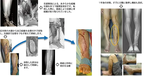 下腿開放骨折