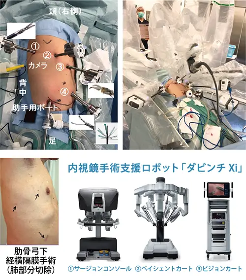 ダビンチXiを用いたロボット手術