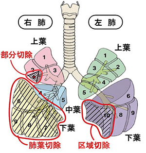 肺区域切除と肺部分切除