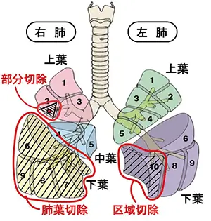 肺区域切除と肺部分切除