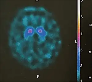 手のふるえについて