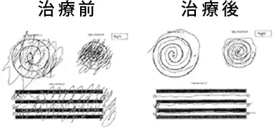 FUS治療の流れ