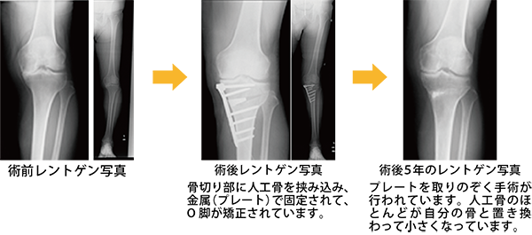 高位脛骨骨切り術