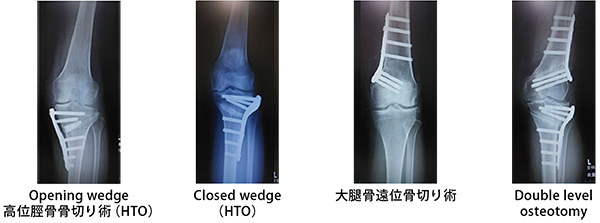 様々な膝周囲骨切り術