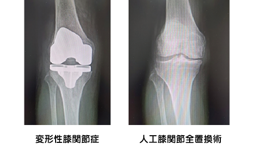 様々な膝周囲骨切り術