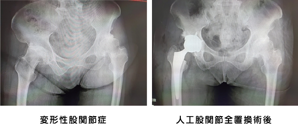 変形性股関節症の手術治療