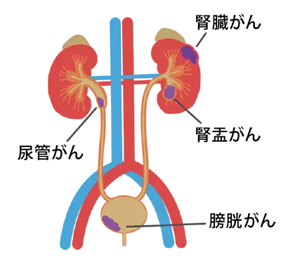 泌尿器科のがん治療