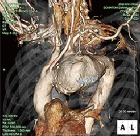 胸部大動脈瘤