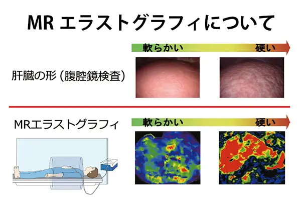 MRエラストグラフィについて