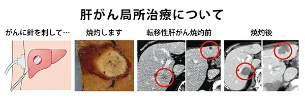 肝がん局所治療について