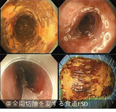 亜全周切除を要する食道ESD